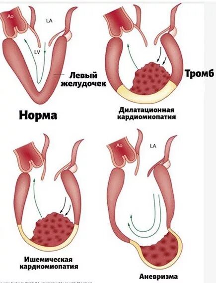 Тромб в желудочке