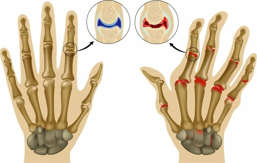 Сильно болят суставы пальцев. Ревматоидный артрит суставы. Ревматоидный артрит деформация суставов. Ревматоидный артрит пястно фаланговый. Ревматоидный артрит дистальные межфаланговые.