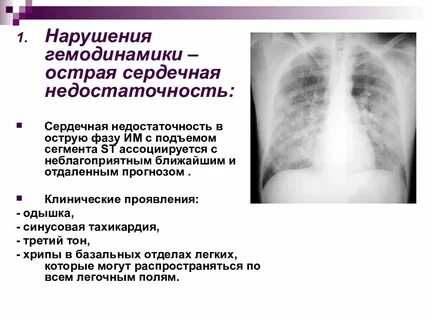 Сердечный хрип