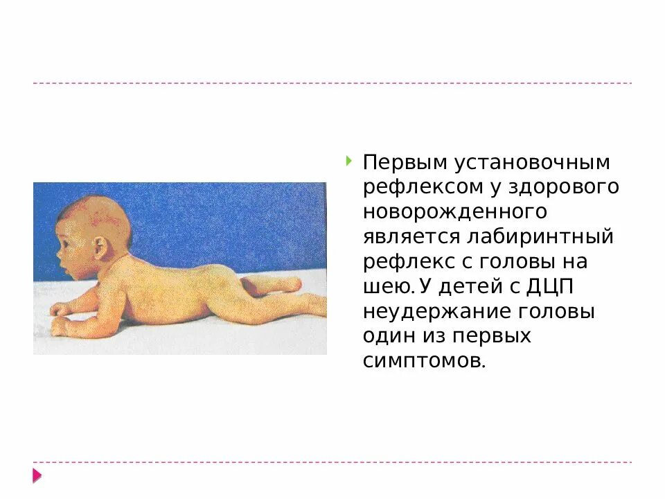 Дцп у новорожденных симптомы. Лабиринтный тонический рефлекс. первые признаки дцп у новорожденных в 2 месяца. как определить дцп у грудничка 2 месяца. дцп у новорожденных симптомы 1 месяц.