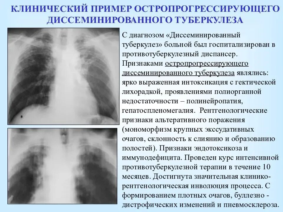 Очаговых и инфильтративных изменений не выявлено