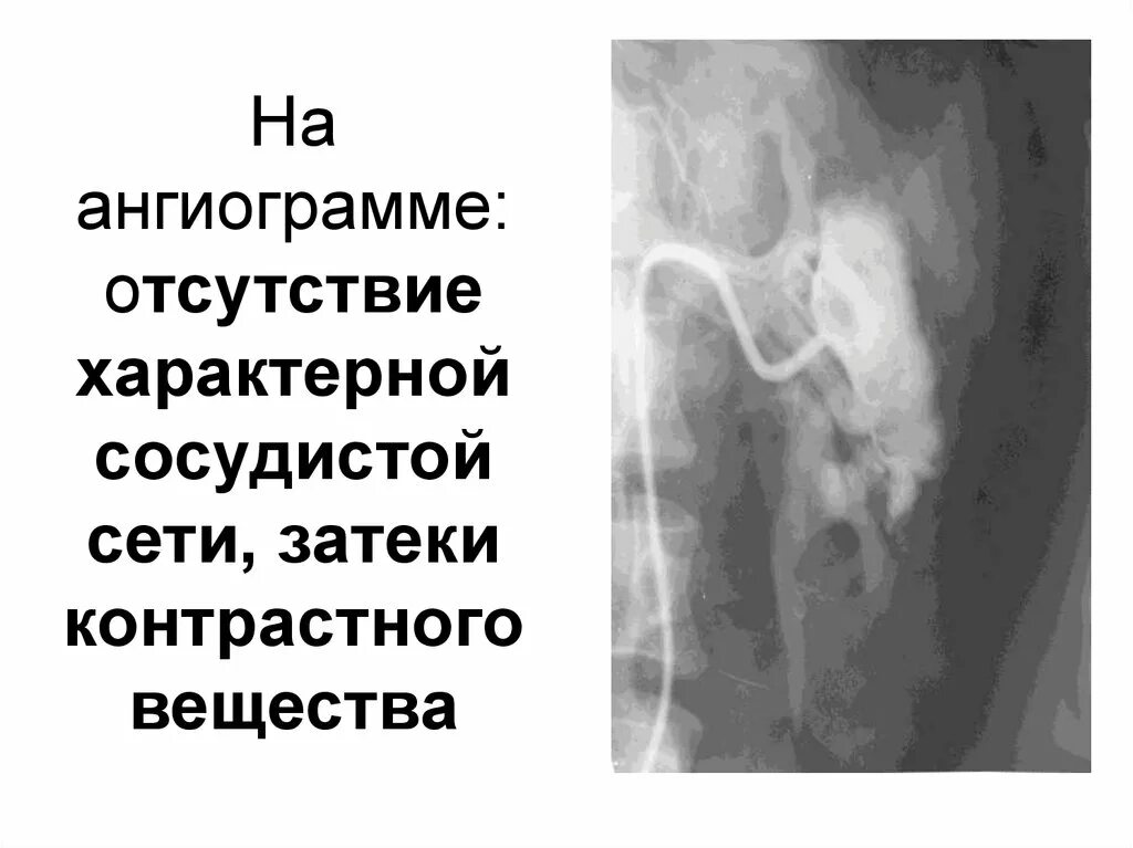 Отсутствие типичных