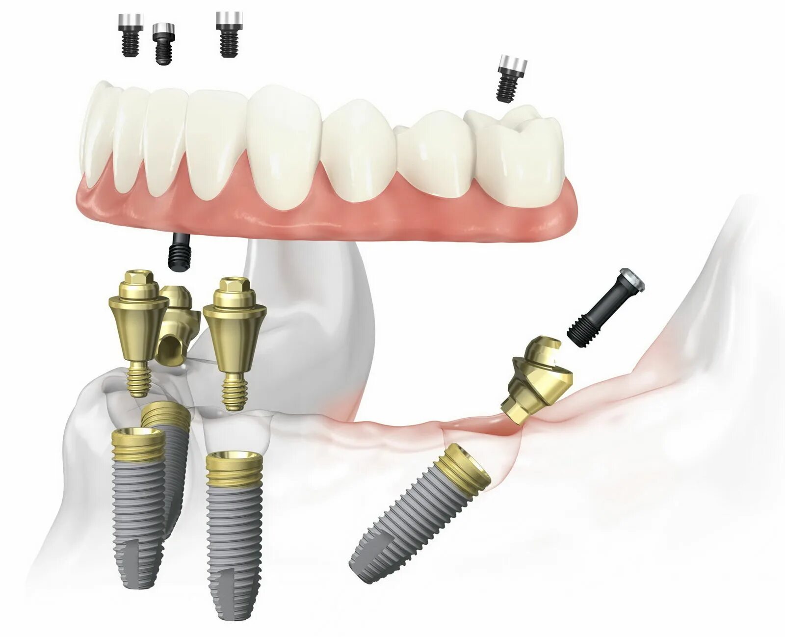 Имплантация зубов all on 6. Straumann импланты 1954. Имплантация зубов all on 4. All on 4 имплантация Нобель.