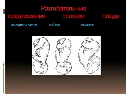 Лицевое предлежание