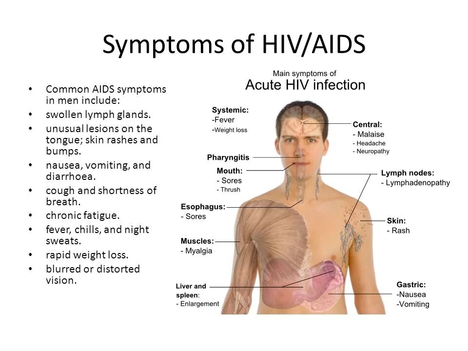 Симптомы заболевания ВИЧ.