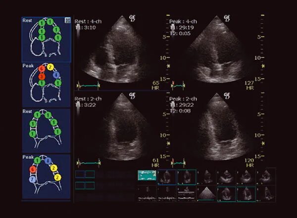 Exokardiografiya. Стресс эхокг. Трансторакальная допплер эхокардиография. Врач узи. Узи сердца аритмии.