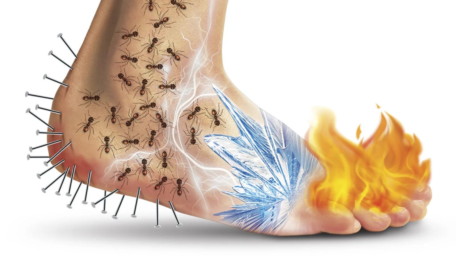 полиневрит