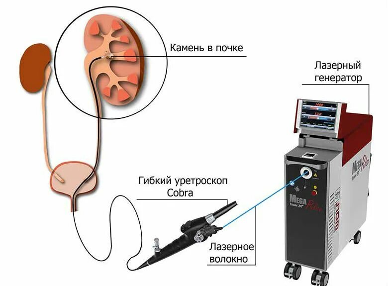Камни в почках как проходит операция. Лазерное дробление камней в почках. аппарат для дробления камней в почках ультразвуком. контактная литотрипсия камней почек. лазерный аппарат для дробления камней в почках.