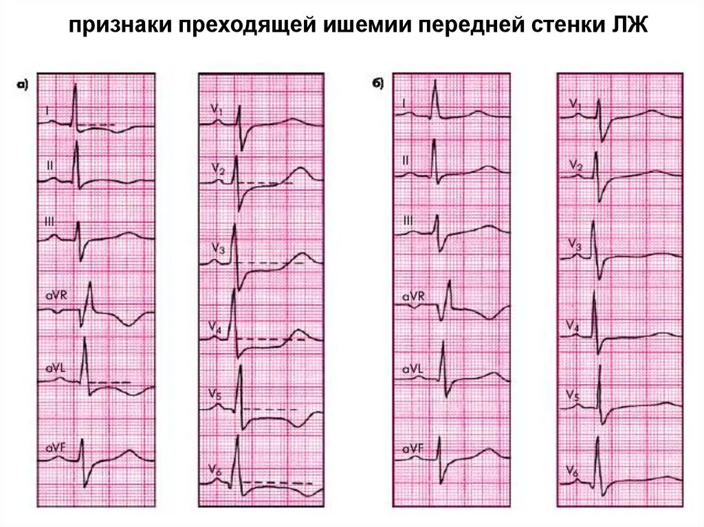 Ишемия боковой стенки