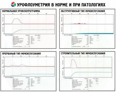 Скорость мочеиспускания