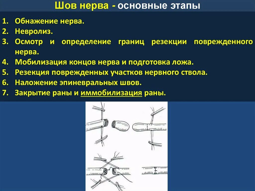 Операция привязки. Шов нерва топографическая анатомия. Принципы наложения шва нерва. Этапы наложения швов на нерв. Этапы операции шва нерва.