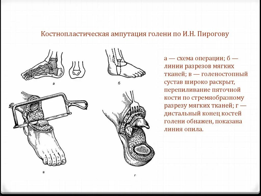 Лоскутная ампутация. Костнопластическая ампутация голени по н.и.Пирогову. Костно пластическая ампутация Пирогова. Пирогов костно-пластическая ампутация голени. Костно-пластическая ампутация голени по Пирогову инструменты.