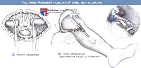 Удаление большой подкожной