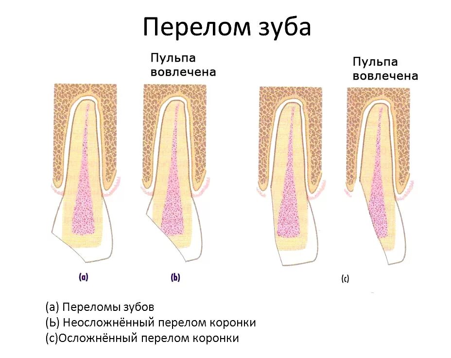 Коронково-корневой перелом зуба. Перелом коронки и корня зуба. Перелом и вывих корня зуба. Перелом корня зуба классификация.