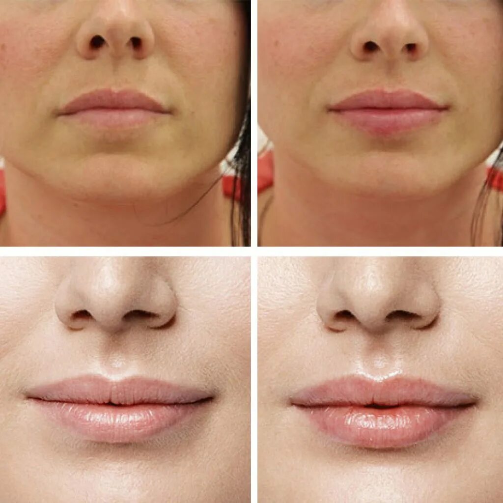Контурные губы до и после фото. Коррекция губ гиалуроновой кислотой 1 мл. Хейлопластика булхорн.