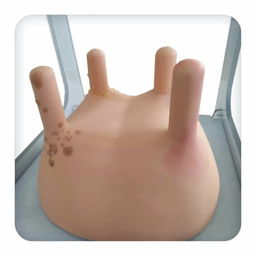 Суппуративный гидраденит. Ведьмино вымя. Ведьмино вымя. Ликогала древесинная плазмодий. Козья форма вымени у коров.