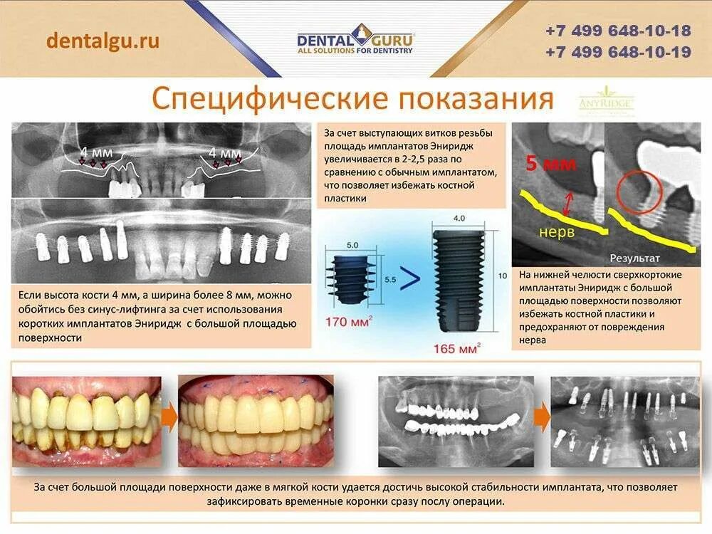 Что нельзя делать после имплантации
