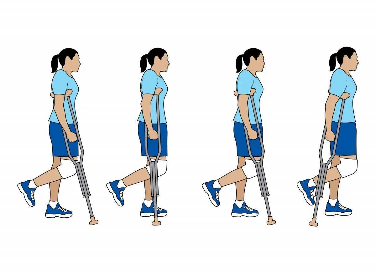 Трость после эндопротезирования. Ходьба на локтевых костылях. Как ходить на костылях. Техника хождения на костылях. Правильная ходьба на костылях.