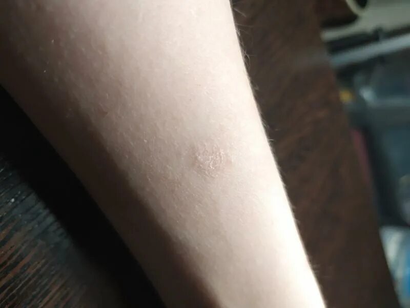 Tinea versicolor - Wikipedia
