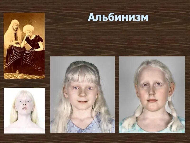 Альбинизм генетика. Альбинизм наследственное заболевание. альбинизм соотношение полов. альбинизм презентация генетика.
