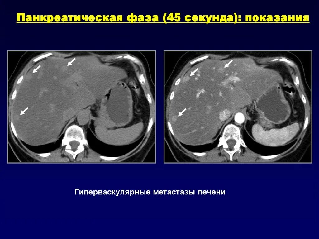 Гиперваскулярные образования печени на кт. Гиповаскулярные метастазы печени кт. Гиперваскулярный метастаз печени на кт. Гиповаскулярные метастазы печени мрт. Рак метастазы в печень лечение