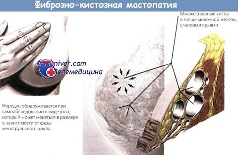 Мастопатия с фиброзным компонентом что это