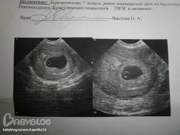Плодное яйцо не соответствует. Узи 5-6 недель плодное яйцо 12мм. узи беременности на ранних сроках 4 недели. узи снимок на 6 акушерской неделе.