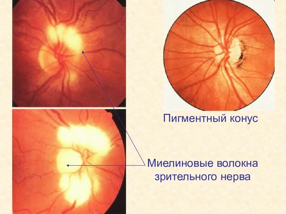 Миелиновые волокна ДЗН. Глазное дно миелиновые волокна. Миелиновые волокна диска зрительного. Миелиновые нервные волокна сетчатки.