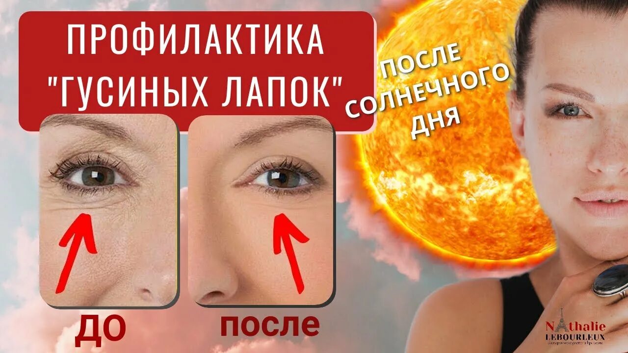Как избавиться от гусиных. Массаж от гусиных лапок. упражнения от гусиных лапок вокруг глаз. маска от гусиных лапок. как избавиться от гусиных лапок на лице.