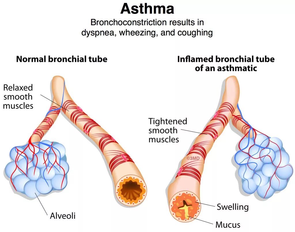 Бронхиальная астма отек легких. Обструкция бронхов. Обструкция мелких бронхов. Обструктивный бронхит бронхи. Обструкция бронхов при бронхиальной астме.