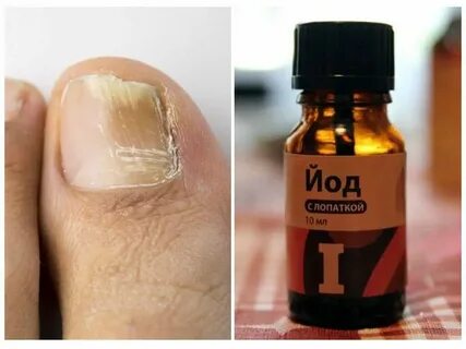 Йод для ногтей