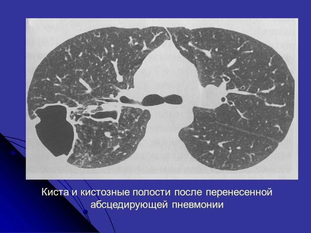 Образование полостей в легких