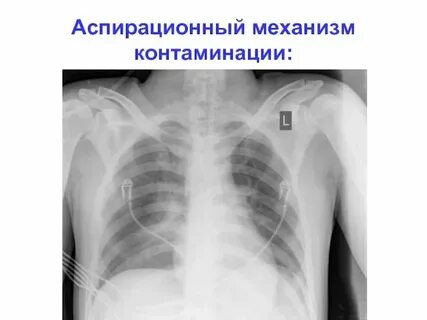 Аспирационный передача инфекции