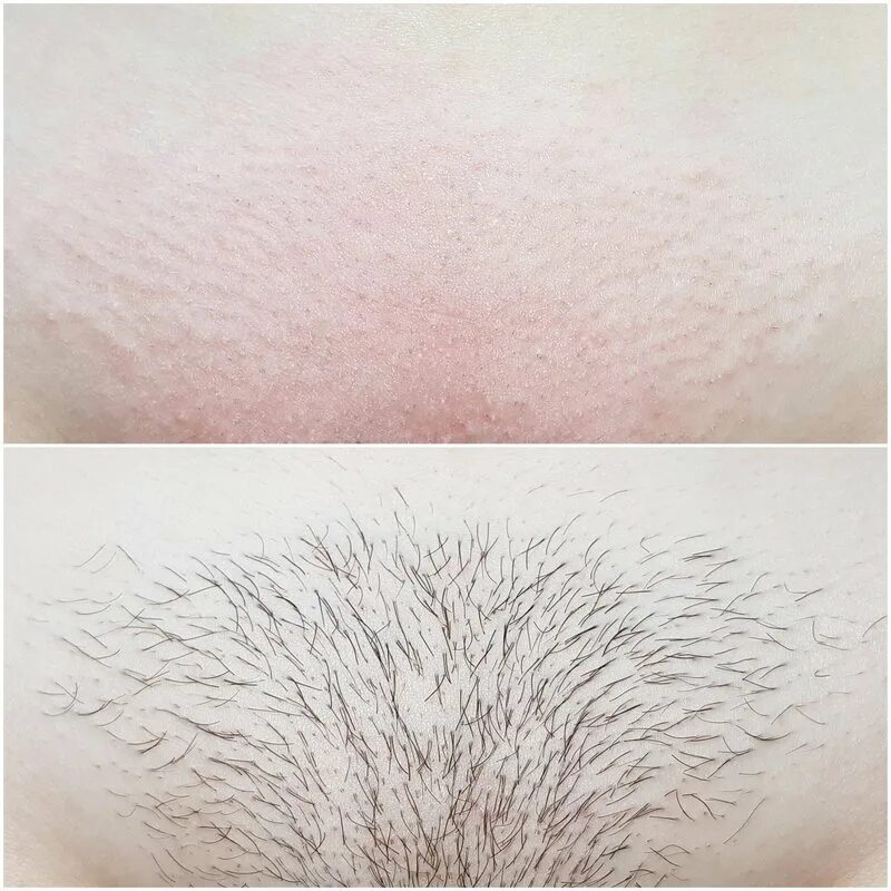 Фотоэпиляция лазерная глубокое бикини. Электроэпиляция зоны глубокого бикини. Шугаринг глубокое бикини. Шугаринг глубокое бикини. Эпиляция бикини отзывы.