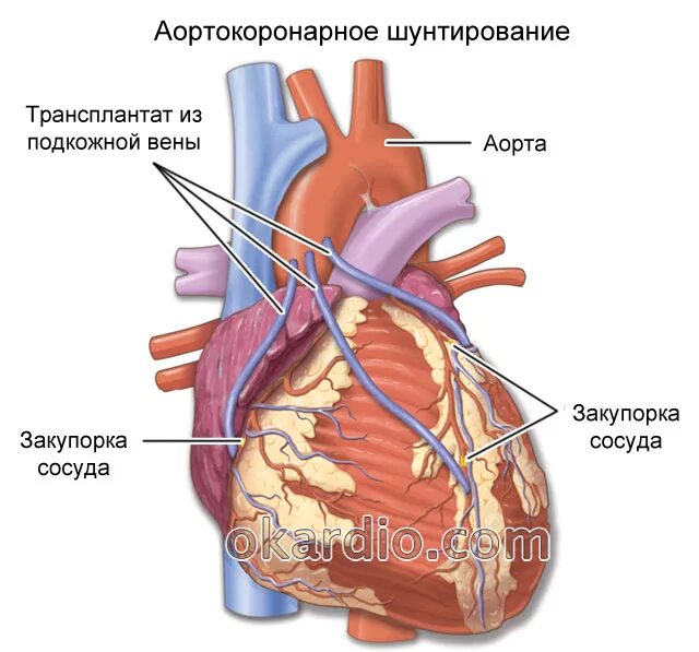 Коронарное шунтирование сосудов сердца. Аортально коронарное шунтирование. Схема операции аортокоронарного шунтирования. Шунтирование коронарных артерий сердца.