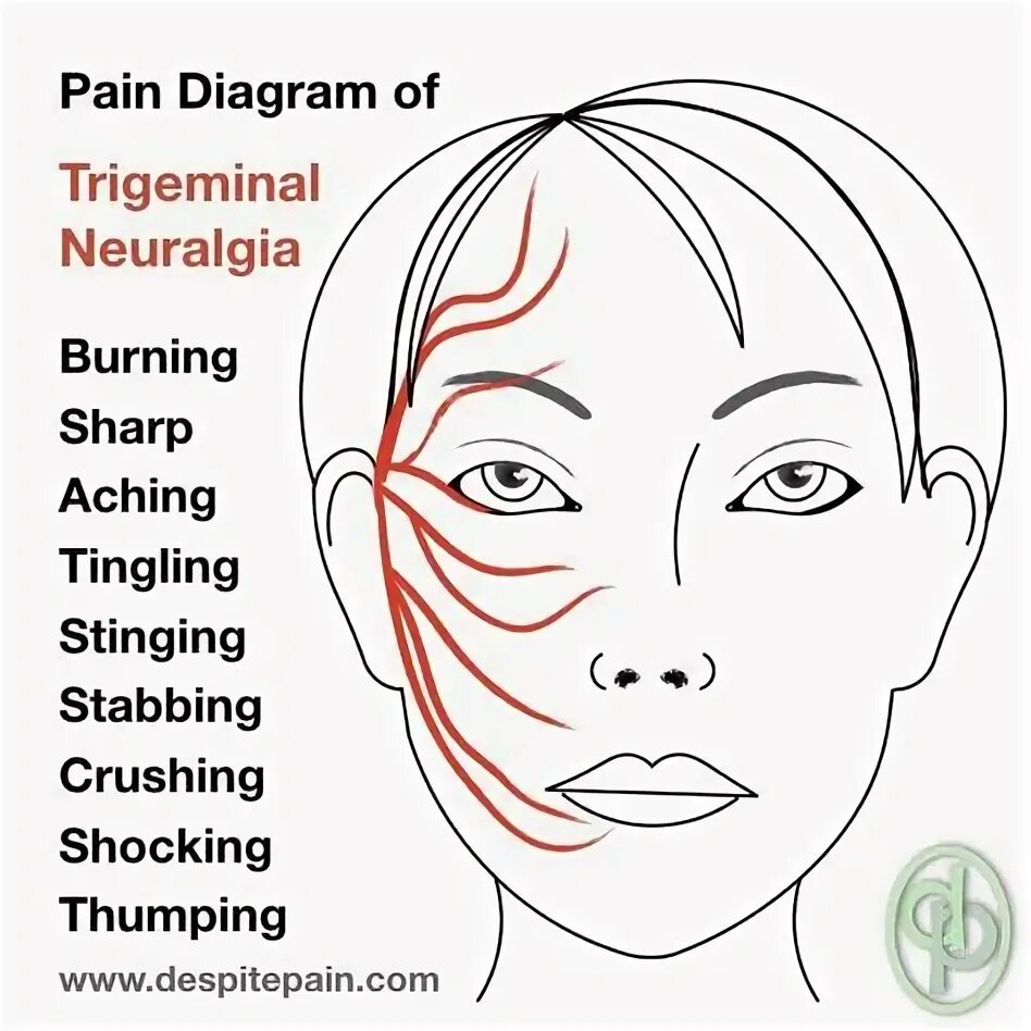 Neuralgia латынь. Trigeminal neuralgia.