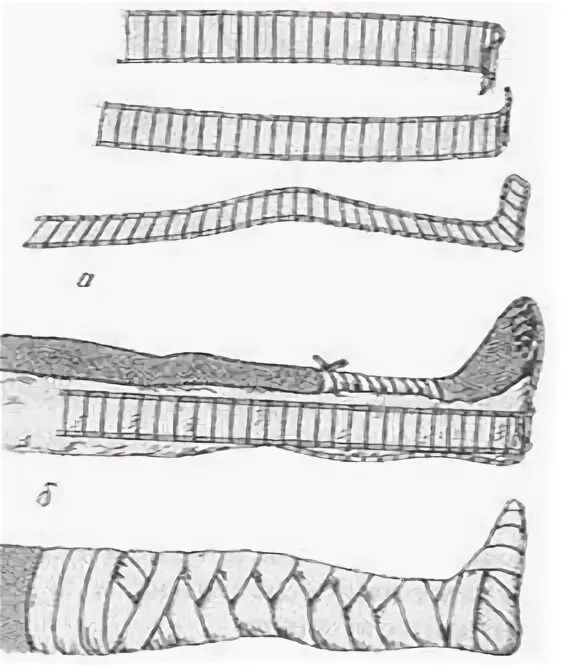 Техника наложения шин при переломах