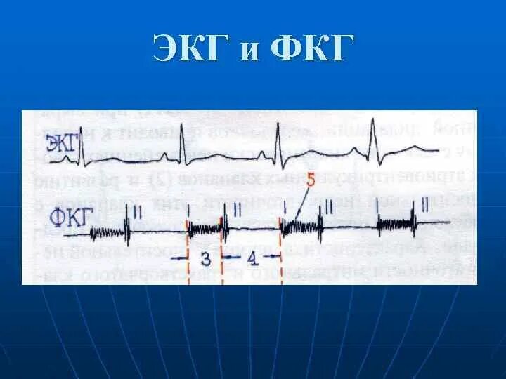 Графическое изображение фкг. Недостаточность трехстворчатого клапана экг. сопоставление экг и фкг. фонокардиография и электрокардиография. фкг и экг плода.
