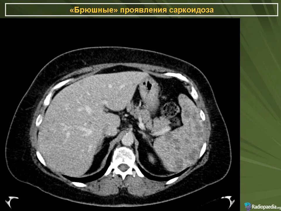 Диффузные изменения печени кт