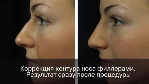 Коррекция носа филлером