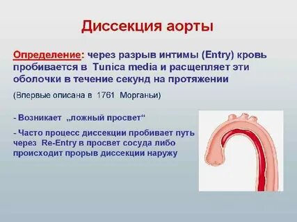 Острое расслоение аорты