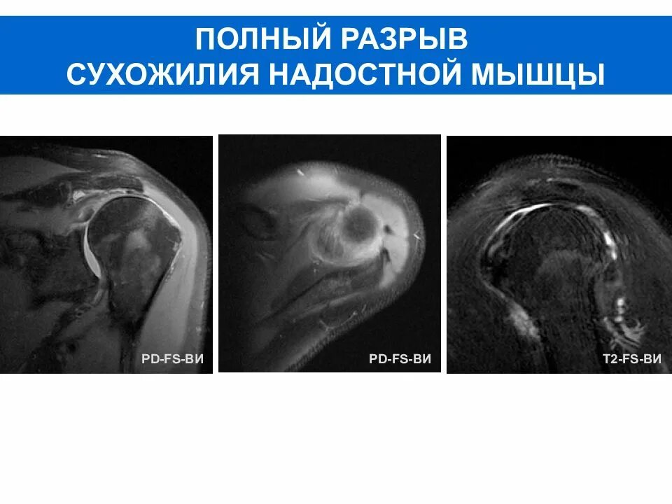 Разрыв вращательной манжеты плечевого сустава мрт. Повреждение надостной мышцы плечевого сустава на мрт. Тендинит сухожилия надостной мышцы мрт. Разрыв надостной мышцы мрт.