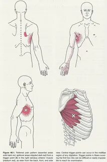 Триггерные точки трапециевидной мышцы - 57 фото