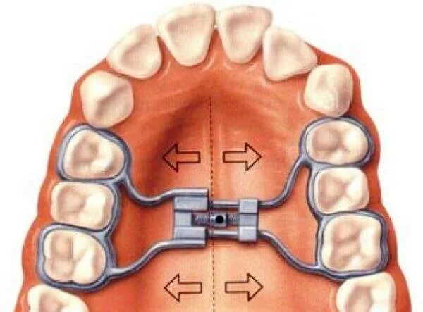 Аппарат Дерихсвайлера ортодонтия. Аппарат для расширения верхней челюсти Дерихсвайлера. Несъемный аппарат Дерихсвайлера. Пластина для расширения верхней челюсти. Аппарат хасса