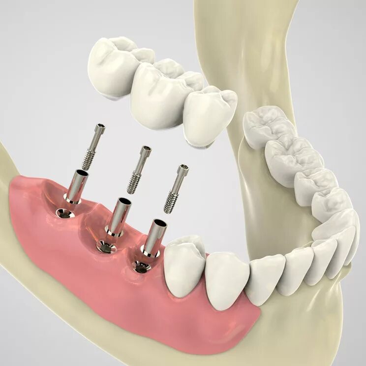 сколько сейчас стоит имплант