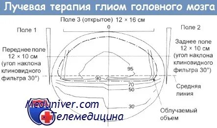 Терапия после лучевой головного мозга