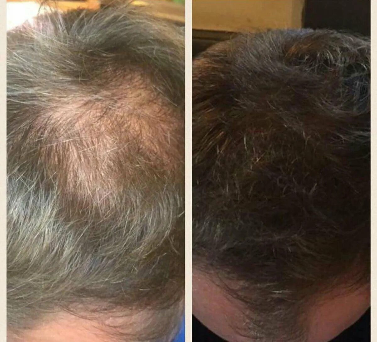 После наркоза выпадают. Выпадение волос до и после. Плазмотерапия для волос до и после. Плазмотерапия волосистой части головы. Мезотерапия волос до и после.