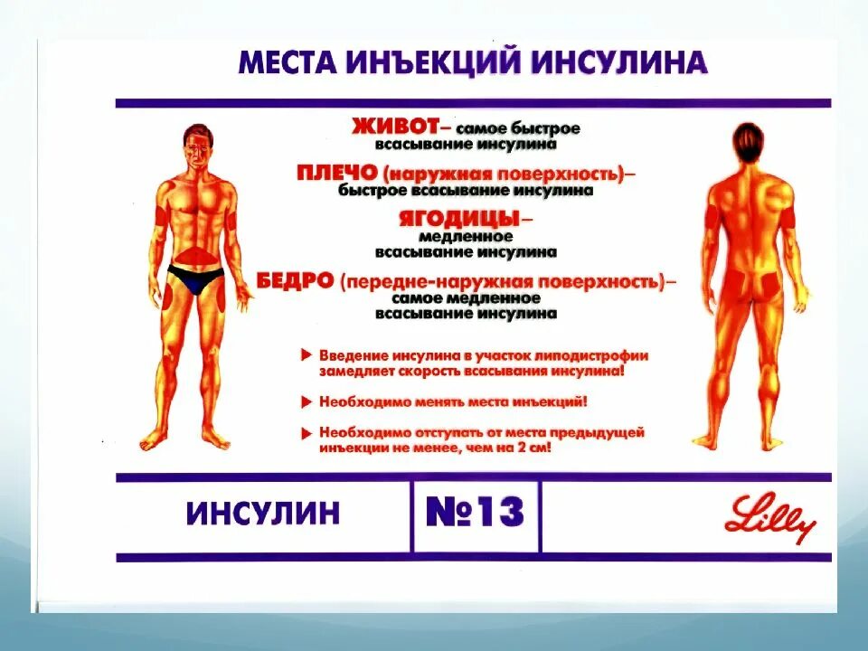 Инъекции инсулина места введения. Схема мест ввода инсулина. Зоны введения инсулина диабетикам. Места инъекций инсулина. Места введения инсулина при сахарном.
