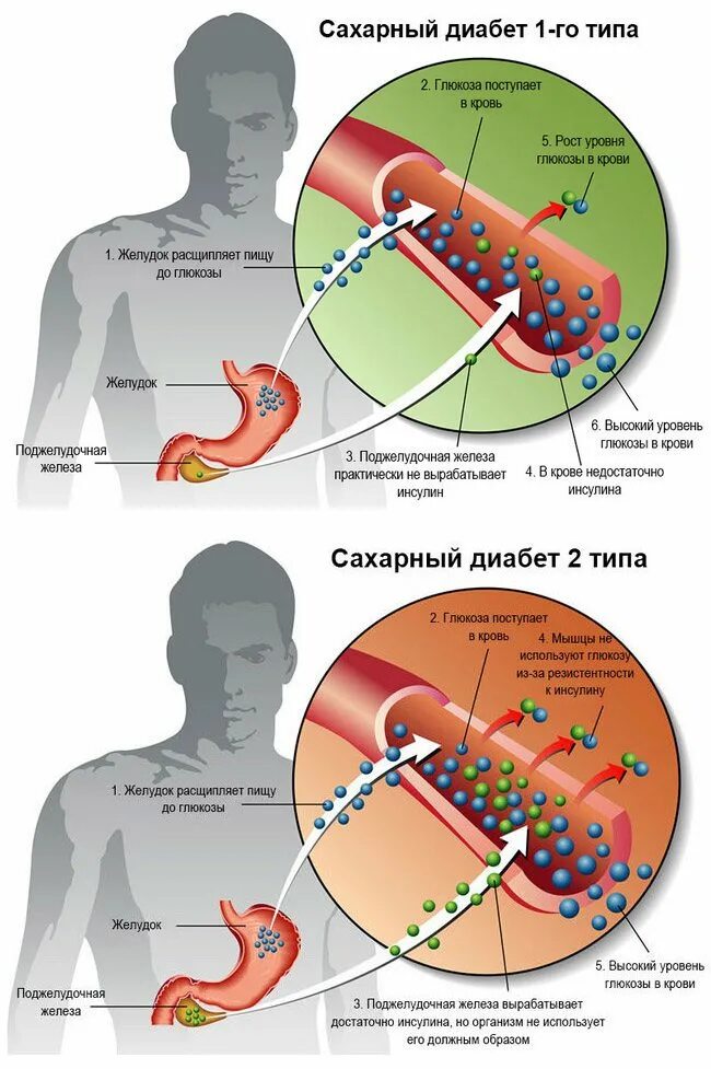 Сахарный диабет. Сахарный диабет 1 ти 2 типа. Диабет 1 типа. Больной сахарным диабетом 1 типа. Сильные боли сахарном диабете