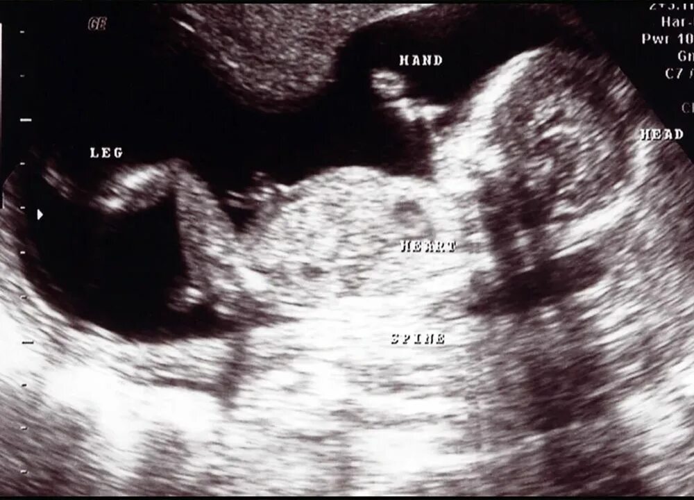 ктг норма. узи шевеление плода. узи ребенка 17 недель узи. оценка состояния плода методом ктг. узи животика.